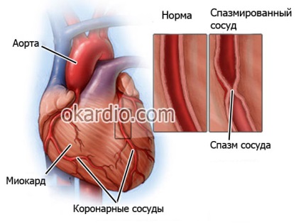 A myocardialis infarktus hat fő oka a férfiaknál és a nőknél