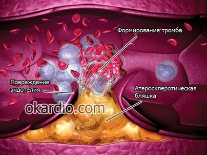 A myocardialis infarktus hat fő oka a férfiaknál és a nőknél