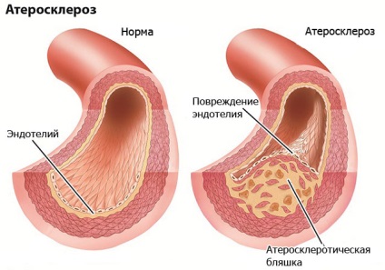 Șase cauze majore ale infarctului miocardic la bărbați și femei