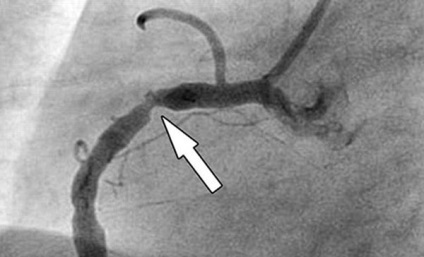 A myocardialis infarktus hat fő oka a férfiaknál és a nőknél