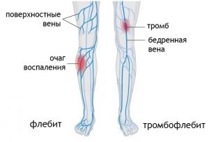 Érbetegségek a lábak tünetei és kezelése