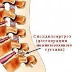 Spondilartroza spinării toracice cauzează, simptome, tratament