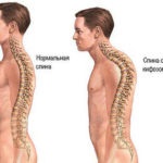 Spondilartroza spinării toracice cauzează, simptome, tratament