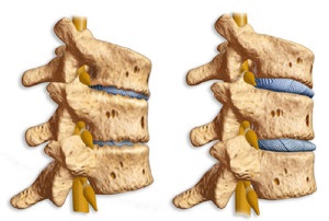 Spondilartroza coloanei vertebrale toracice 1