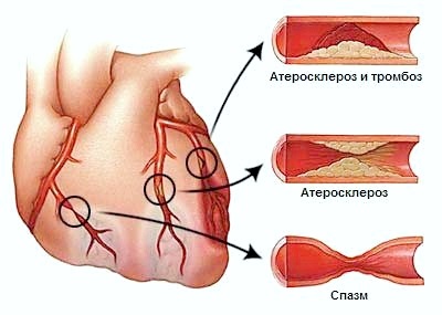 Angina pectorală (angina pectorală)