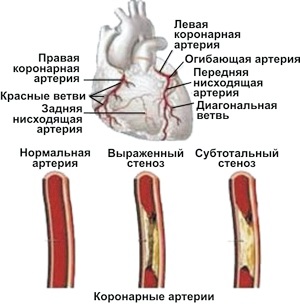 Angina pectoris (angina pectoris)