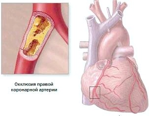 Angina pectorală (angina pectorală)