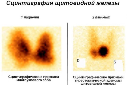 Сцинтиграфия на щитовидната жлеза - какви са те, странични ефекти като поведение