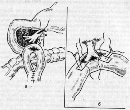 Fistula pancreasului și tratamentul acestuia