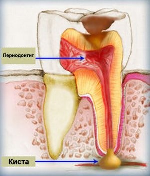 Tratamentul terapeutic al chistului dentar și simptomele și prețul acestuia