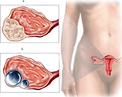 Teatrul ovarian ce este, îndepărtarea laparoscopică a tumorii la femei