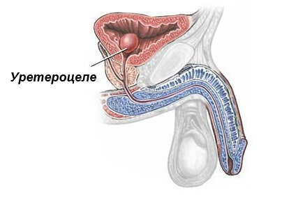 Rezecția transuretrală a ureterocelei - clinica cu bilak