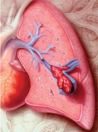 Tromboembolismul arterei pulmonare (teela) - cauze, simptome și tratament