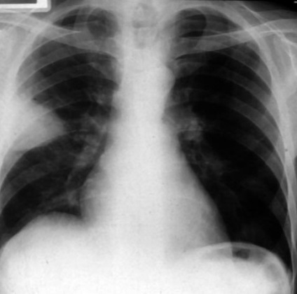 Tromboembolismul arterei pulmonare (teela) - cauze, simptome și tratament