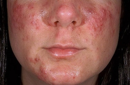 Acnee pe fața cauzei și tratamentul, tipuri de acnee