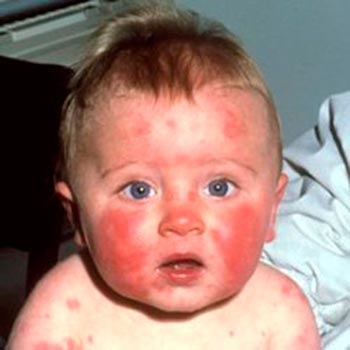 A gyermek 3 hónapig arcán allergia, a gyermek 3 hónap