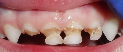 Copilul crumă dintele ce trebuie să facă