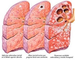 Grijă pentru un pacient acasă cu tuberculoză pulmonară