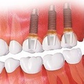 Opțiunile implantului dentar - Cazuri clinice când este necesară implantarea