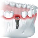 Opțiunile implantului dentar - Cazuri clinice când este necesară implantarea