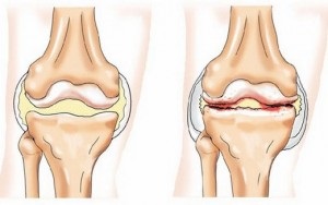 Tipuri de osteochondroză - diagnostic corect