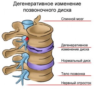 Tipuri de osteochondroză - diagnostic corect