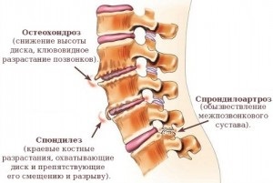 Tipuri de osteocondroză cervicală, toracică, lombară