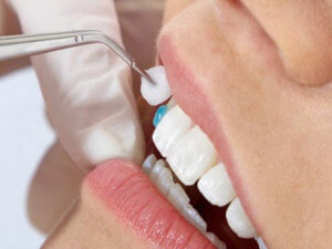 Furnir pe dinți de ce sunt necesare și cum funcționează