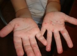 Virusul Coxsackie în Turcia în 2017, în care hotelurile simptomele copiilor adulți pe g