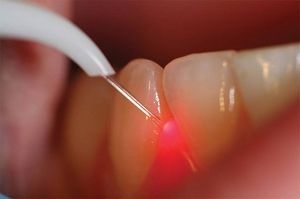 Inflamația gingiilor ce trebuie făcută dacă inflamația gingiilor este observată la copil, sfatul dentar