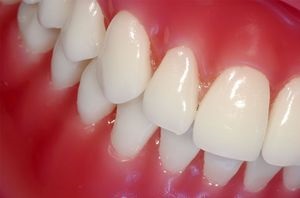 Inflamația gingiilor ce trebuie făcută dacă inflamația gingiilor este observată la copil, sfatul dentar