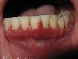 Inflamația gingiilor ce trebuie făcută dacă inflamația gingiilor este observată la copil, sfatul dentar