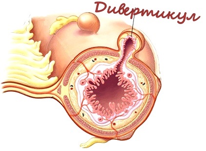 Restaurarea microflorei intestinale