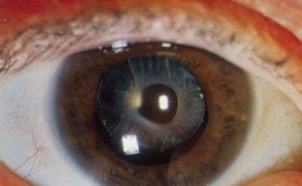 Cataractă congenitală în metodele copiilor de combatere a patologiei
