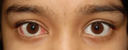 Cataractă congenitală în metodele copiilor de combatere a patologiei
