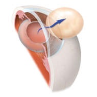 Cataractă congenitală în metodele copiilor de combatere a patologiei