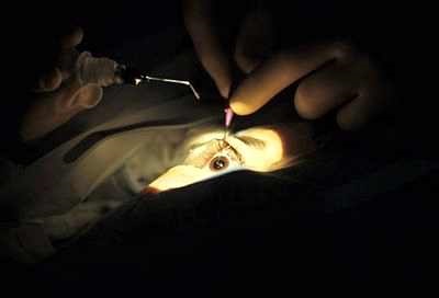 Katarakta műtét Izraelben műtét eltávolítása látás helyreállítása