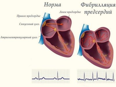 Extrasistul ventricular 1 gradarea a ceea ce este, clasificări