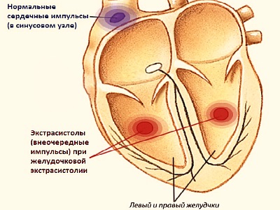 Extrasistul ventricular 1 gradarea a ceea ce este, clasificări