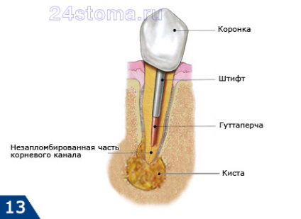 Durerea de dinți sub coroană, stomatologie