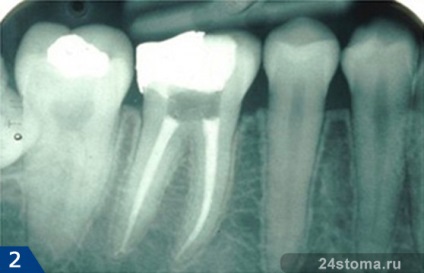Durerea de dinți sub coroană, stomatologie