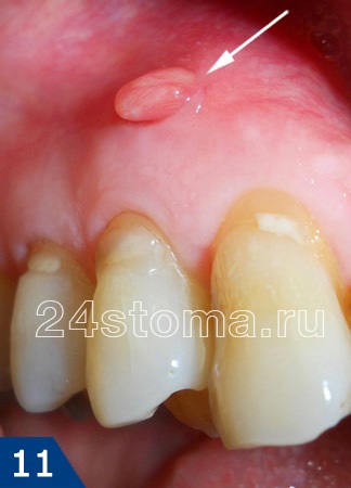 Durerea de dinți sub coroană, stomatologie