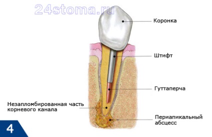 Durerea de dinți sub coroană, stomatologie