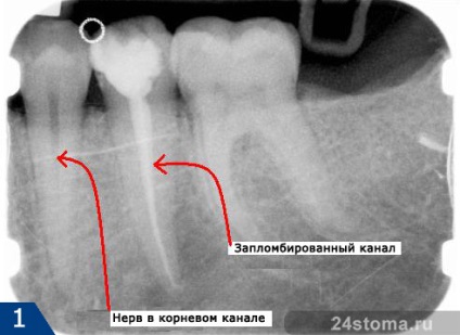 Durerea de dinți sub coroană, stomatologie