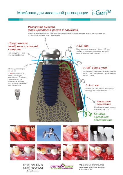 Implanturi dentare preturi, cataloage, preturi