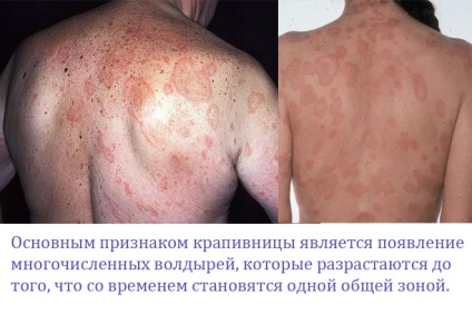 Alergică urticarie erupție cutanată foto, simptomatologie și tratament