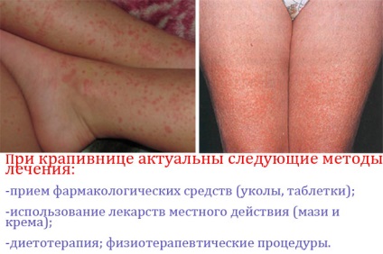 Alergică urticarie erupție cutanată foto, simptomatologie și tratament