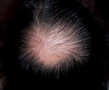 Alopecia la femei, pierderea parului focal, cauze și fotografii