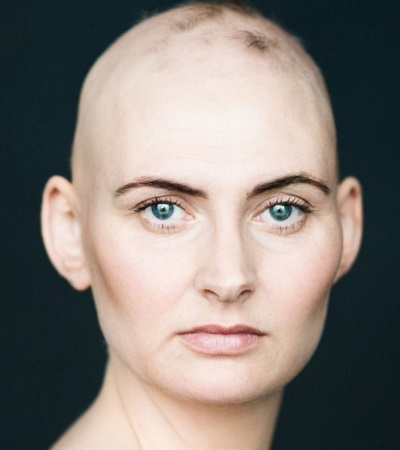 Alopecia a nőkben, gyulladásos hajhullás, okok és fotók