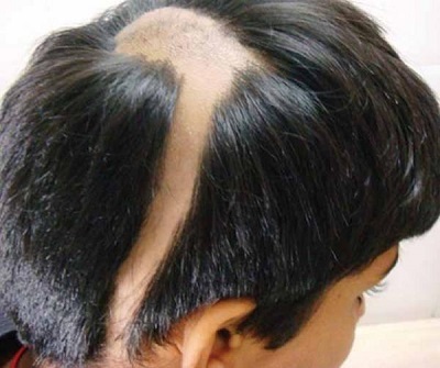 Alopecia la femei, pierderea parului focal, cauze și fotografii